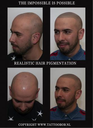 turkish hairtransplantation mhp.jpg