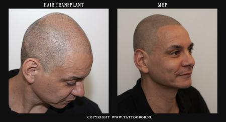 hair transplant 22-10.jpg