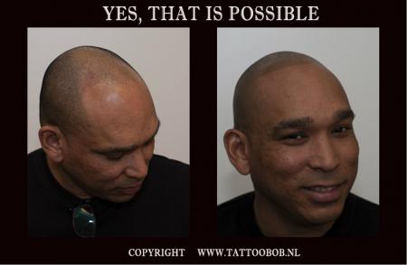 scalp pigmentation 13-5.jpg