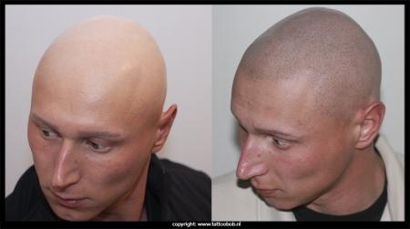 11-10-24-alopecia-verkleind-1.jpg