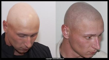 11-10-24-alopecia-verkleind-2.jpg