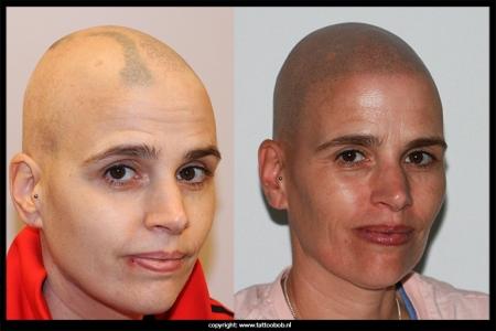 alopecia-voor-en-na-mhp-1.jpg