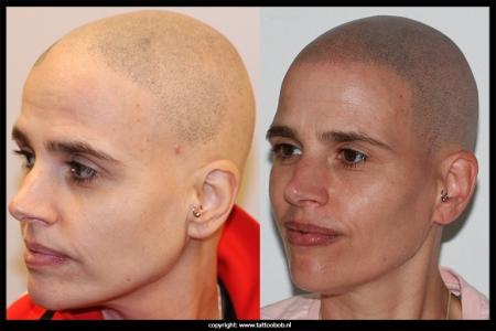 alopecia-voor-en-na-mhp-2.jpg